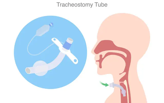 Laryngotomy Procedure