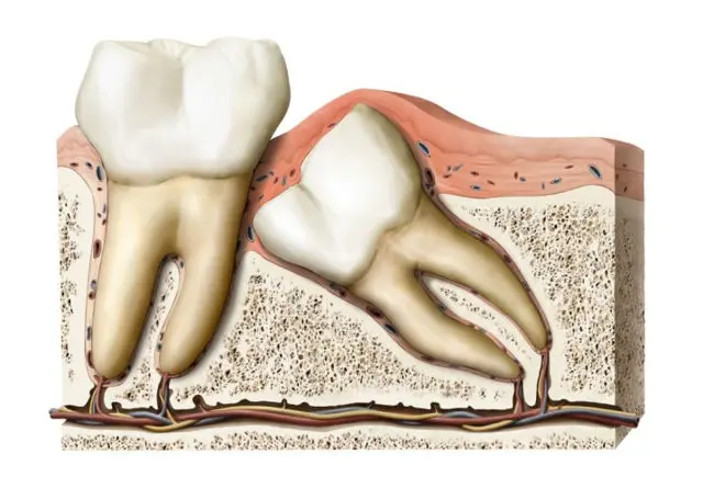 Your Complete Guide: Best Foods to Eat After Wisdom Tooth Extraction ...
